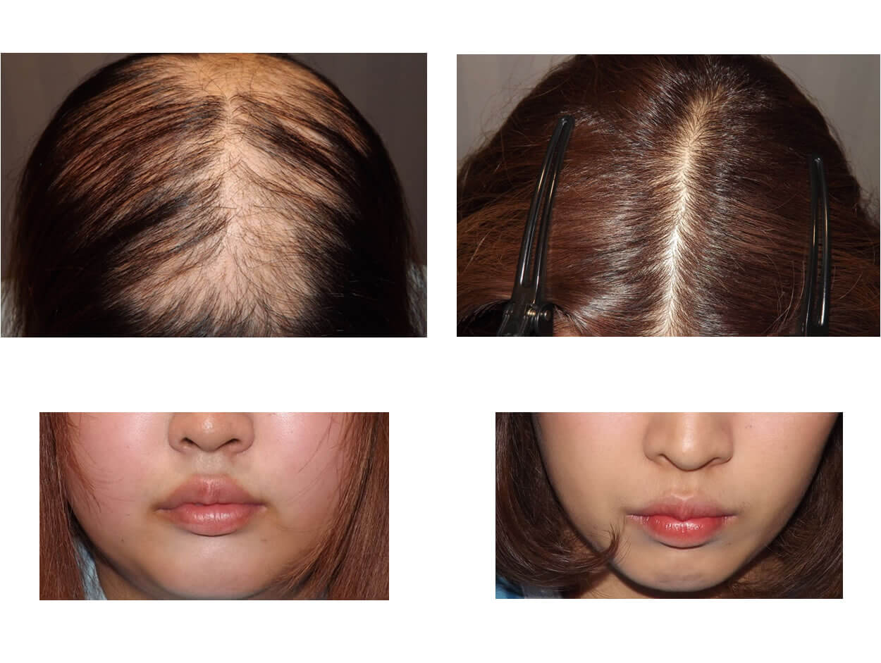 女性の脱毛のその他の原因